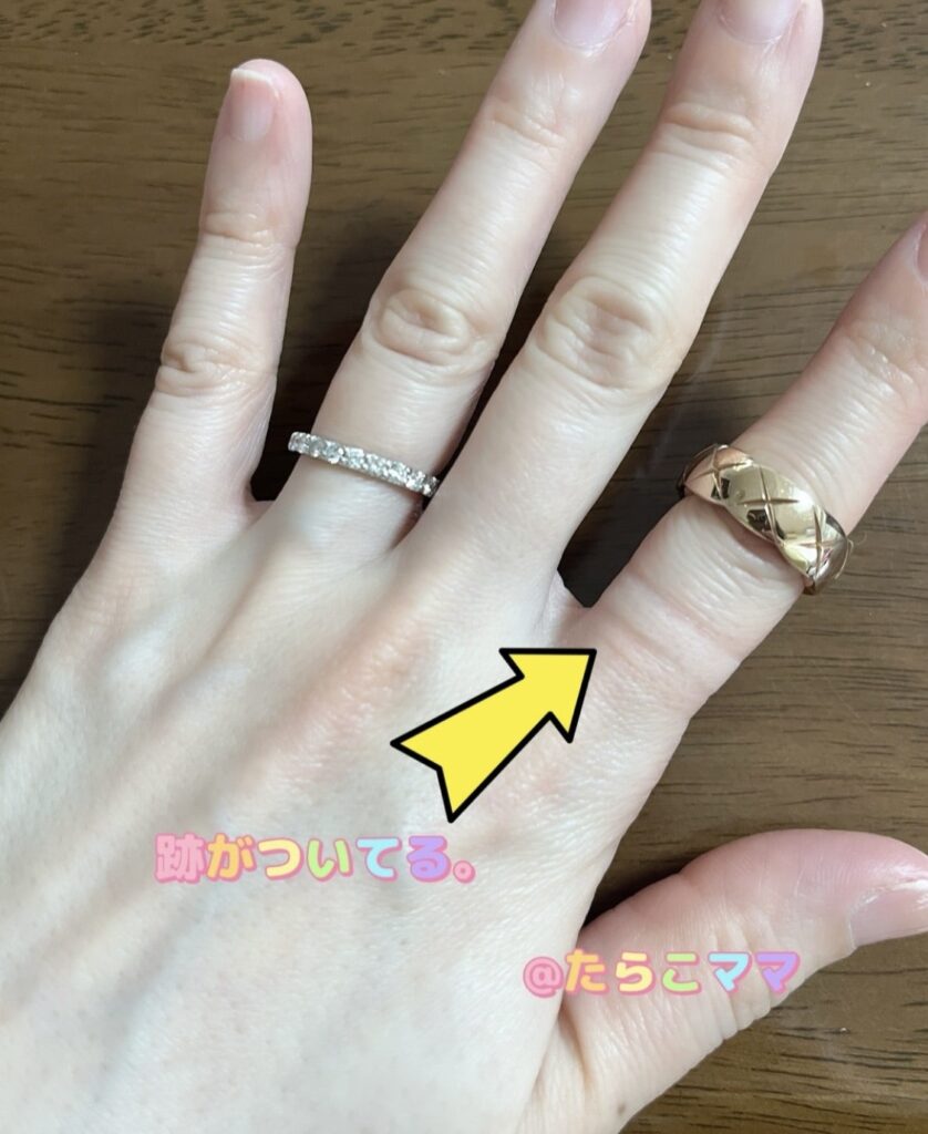 ココクラッシュミディアムリングの跡が指についている写真
